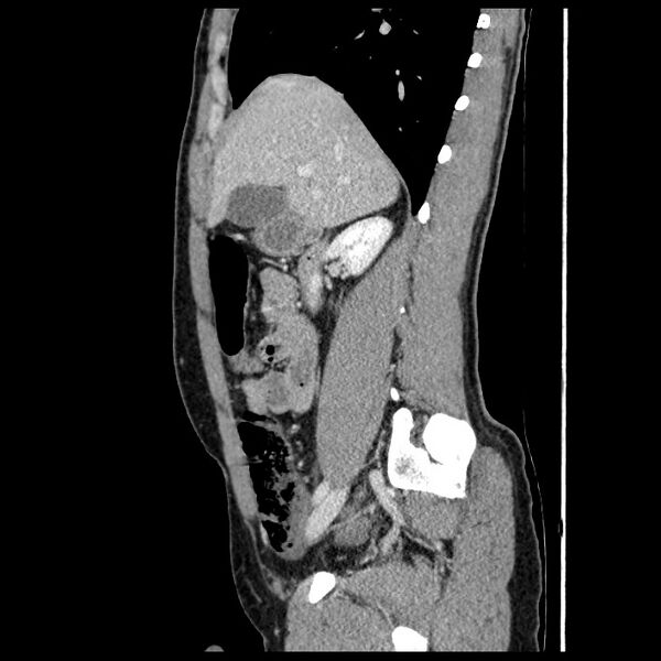 File:Co-existing acute appendicitis and epiploic appendagitis (Radiopaedia 61789-69911 B 32).jpg