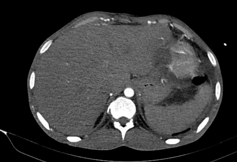 File:Coarctation of aorta with aortic valve stenosis (Radiopaedia 70463-80574 A 218).jpg