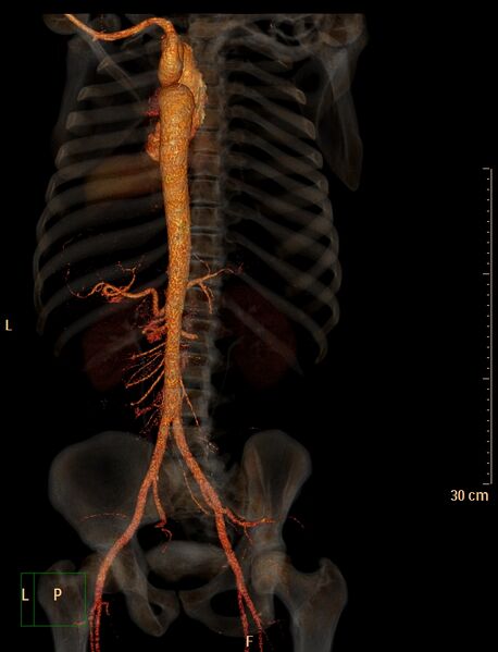 File:Coarctation of the aorta (Radiopaedia 49784-55050 3D VRT 13).jpg