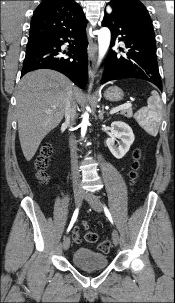 File:Coarctation of the aorta (Radiopaedia 74632-88521 B 135).jpg