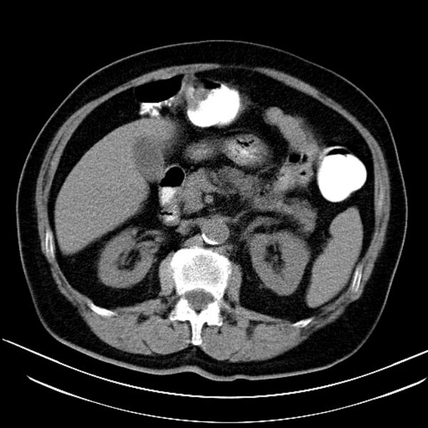 File:Colon adenocarcinoma (Radiopaedia 15157-15025 Axial non-contrast 2).jpg