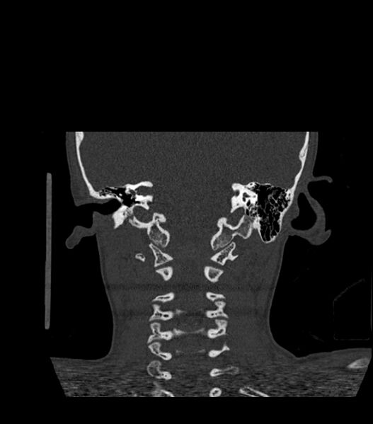 File:Nasoorbitoethmoid fracture (Radiopaedia 90044-107205 Coronal bone window 108).jpg