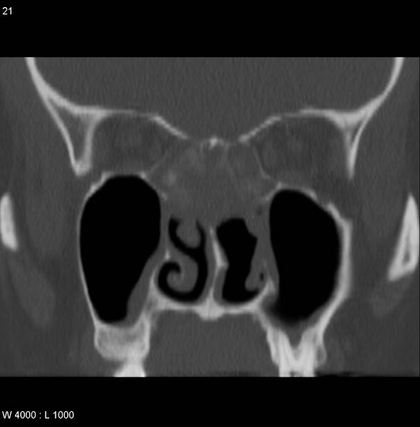 File:Nasopharyngeal carcinoma (recurrent) (Radiopaedia 5061-6903 Coronal bone window 3).jpg