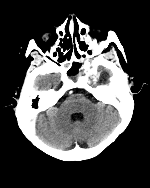 File:Nasopharyngeal carcinoma with cerebral abscess (Radiopaedia 43018-46275 Axial C+ delayed 15).png