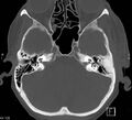 Necrotizing otitis externa (Radiopaedia 19938-19971 Axial bone window 5).jpg