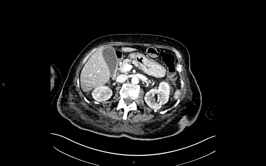 Neo-terminal ileal stricture (Crohn disease) (Radiopaedia 33790-34948 A 146).jpg
