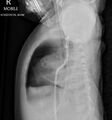 Neonatal pneumothorax (Radiopaedia 27206-27375 Lateral 1).jpg