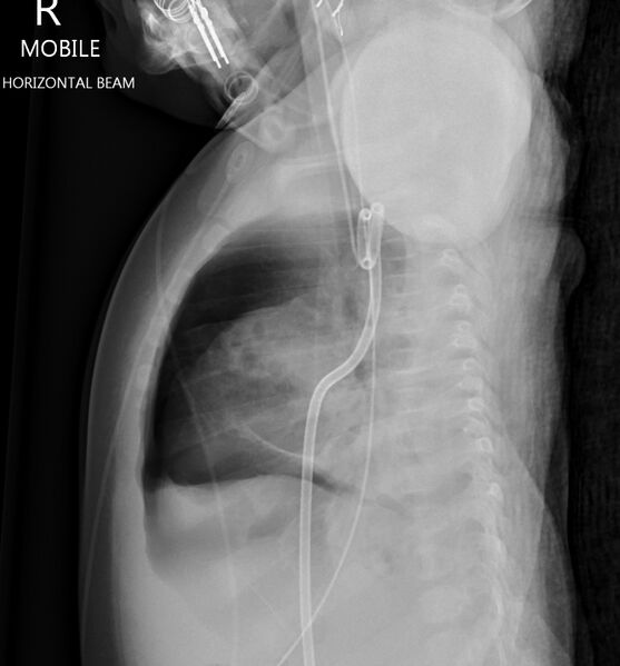 File:Neonatal pneumothorax (Radiopaedia 27206-27375 Lateral 1).jpg