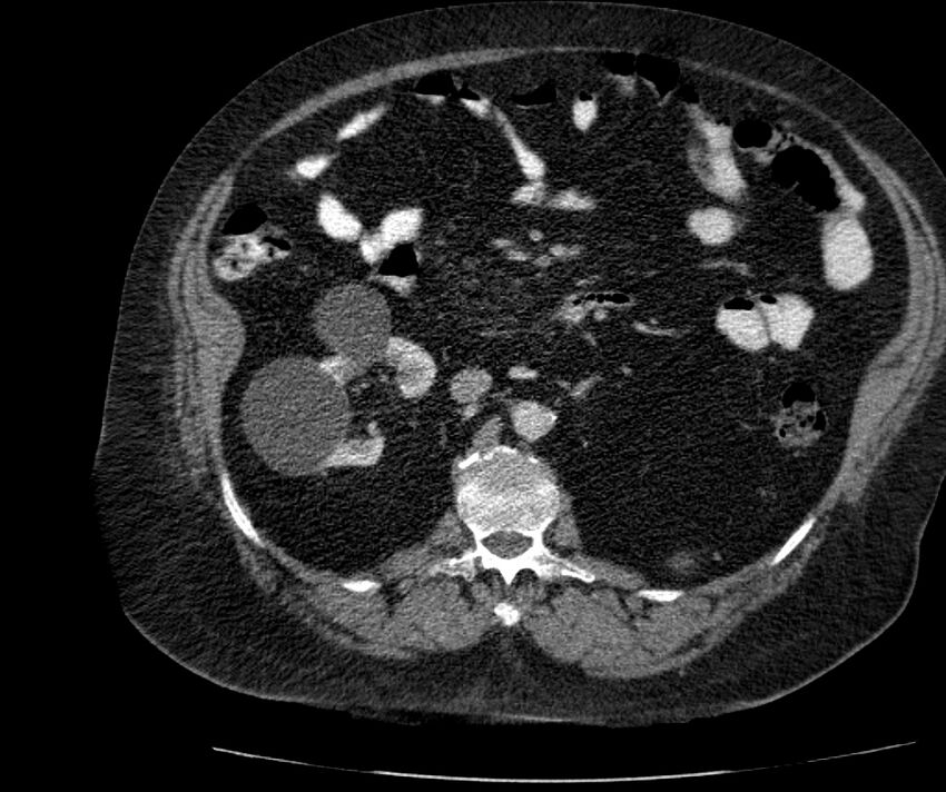 Nephroptosis with inguinal hernia containing perirenal fat (Radiopaedia 56632-63391 C 147).jpg