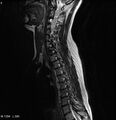 Neurofibromatosis type 2 - cranial and spinal involvement (Radiopaedia 5351-7112 Sagittal T2 2).jpg
