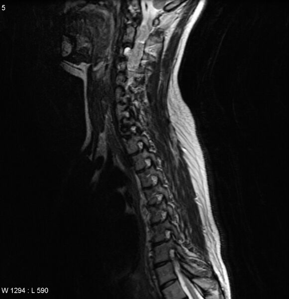 File:Neurofibromatosis type 2 - cranial and spinal involvement (Radiopaedia 5351-7112 Sagittal T2 2).jpg