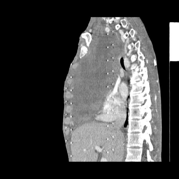 File:Non hodgkin lymphoma of the mediastinum (Radiopaedia 20814-20729 D 11).jpg