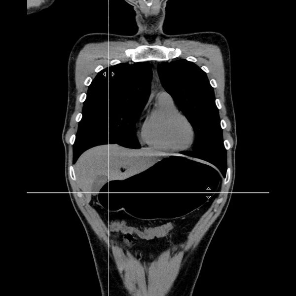 File:Normal CT virtual gastroscopy (Radiopaedia 29960-30501 D 1).jpg