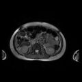 Normal MRI abdomen in pregnancy (Radiopaedia 88001-104541 Axial Gradient Echo 24).jpg