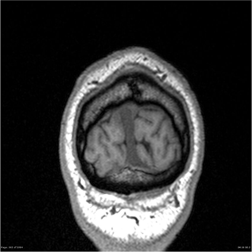 Normal brain MRI (non-focal epilepsy protocol) (Radiopaedia 38571-40700 Coronal T1 7).jpg
