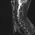 Normal cervical spine MRI (Radiopaedia 38418-40496 Sagittal STIR 4).jpg
