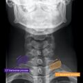 Normal cervical spine radiographs (Radiopaedia 32505-96697 B 6).jpeg