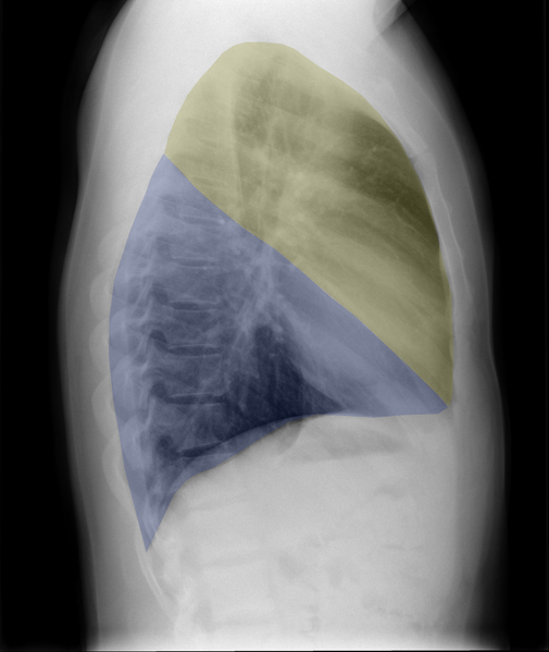 File:Normal chest x-ray - lobes (illustration) (Radiopaedia 58938-66192 C 1).png