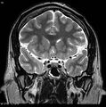 Normal coronal brain (Radiopaedia 6676-7910 Coronal T2 15).jpg
