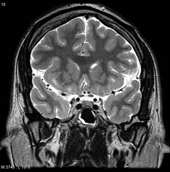 File:Normal coronal brain (Radiopaedia 6676-7910 Coronal T2 15).jpg