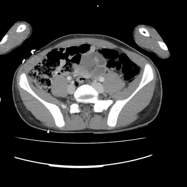 File:Normal dual-phase trauma CT chest,abdomen and pelvis (Radiopaedia 48092-52899 A 89).jpg