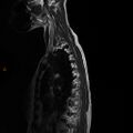 Normal spine MRI (Radiopaedia 77323-89408 E 1).jpg