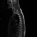 Normal spine MRI (Radiopaedia 77323-89408 E 2).jpg