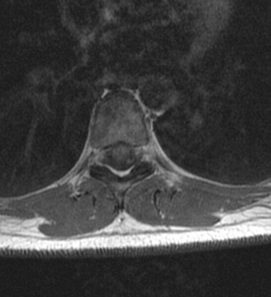 File:Normal thoracic spine MRI (Radiopaedia 41033-43781 Axial T1 1).jpg