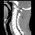 Normal trauma cervical spine (Radiopaedia 41017-43760 B 12).png