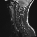 Normal trauma cervical spine (Radiopaedia 41017-43762 Sagittal T2 12).png