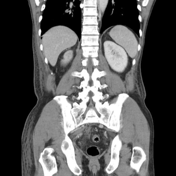 File:Obstructive bladder transitional cell carcinoma (Radiopaedia 9825-10410 B 21).jpg