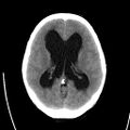 Obstructive hydrocephalus (Radiopaedia 30453-31119 Axial non-contrast 14).jpg