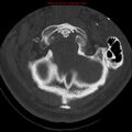 Occipital condyle fracture (Radiopaedia 18366-18208 Axial bone window 13).jpg