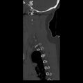 Occipital condyle fracture (Radiopaedia 31755-32691 Sagittal bone window 5).jpg