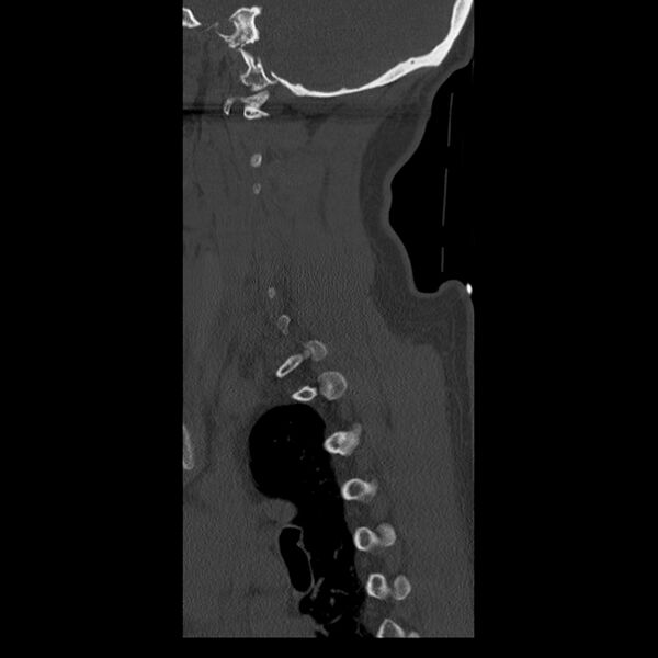 File:Occipital condyle fracture (Radiopaedia 31755-32691 Sagittal bone window 5).jpg