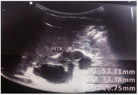 Right dysplastic kidney with the largest cyst size measuring 33.16mm