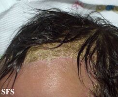 Seborrhoeic dermatitis head