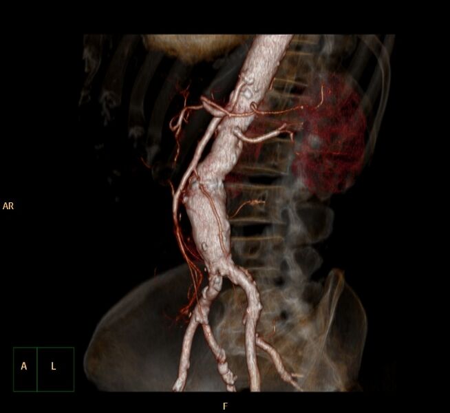 File:Abdominal aortic aneurysm (Radiopaedia 23703-23856 3D 22).jpg