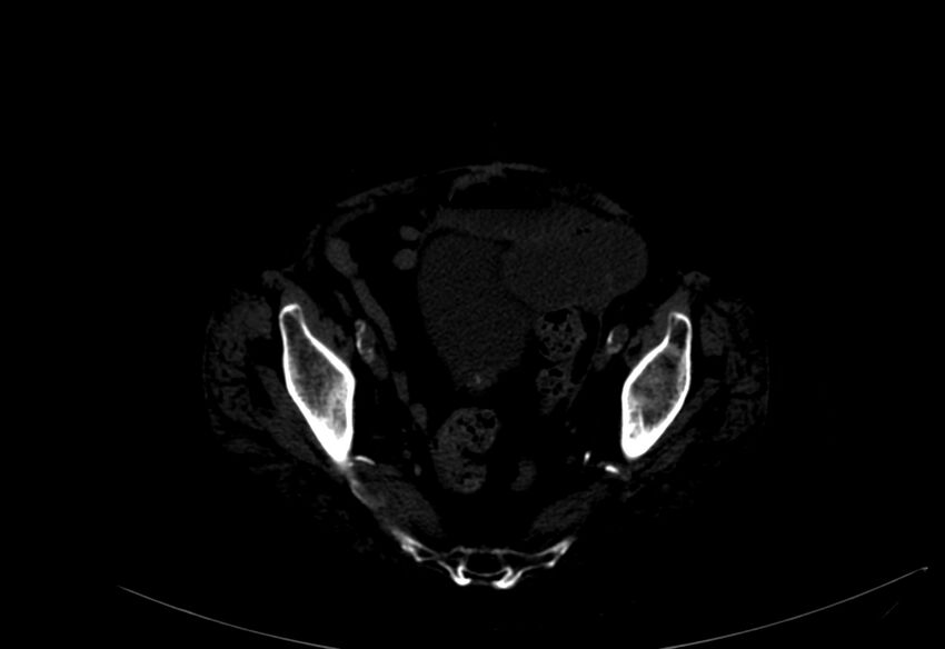 Abdominal aortic aneurysm - impending rupture (Radiopaedia 19233-19246 B 55).jpg