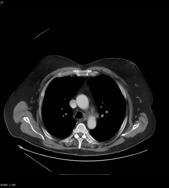 File:Abdominal aortic aneurysm with intramural hematoma then rupture (Radiopaedia 50278-55631 Axial C+ arterial phase 18).jpg