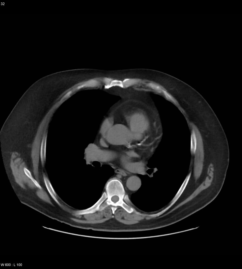 Abdominal aortic aneurysm with intramural hematoma then rupture (Radiopaedia 50278-55631 Axial non-contrast 28).jpg