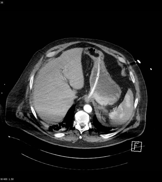 File:Abdominal aortic aneurysm with intramural hematoma then rupture (Radiopaedia 50278-55632 Axial C+ arterial phase 35).jpg