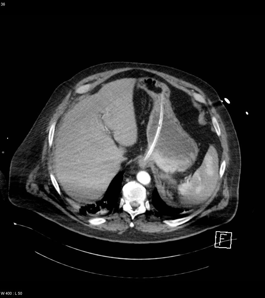 Abdominal aortic aneurysm with intramural hematoma then rupture (Radiopaedia 50278-55632 Axial C+ arterial phase 35).jpg