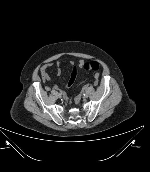 File:Abdominal aortic aneurysm with thrombus fissuration (Radiopaedia 46218-50618 Axial non-contrast 44).jpg
