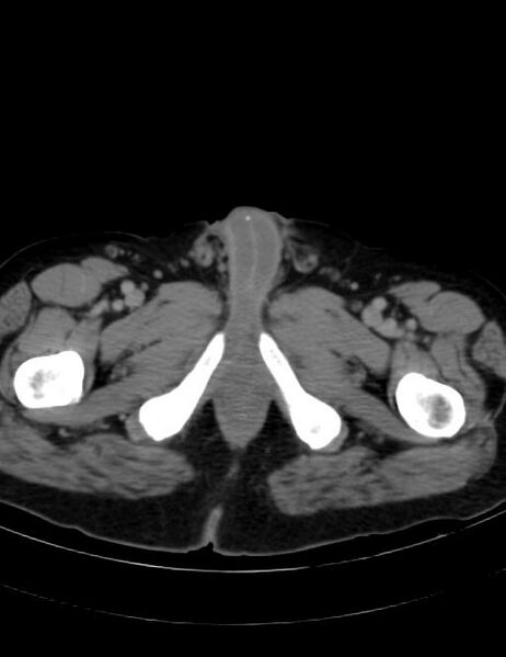 File:Abdominal lymphoma - with sandwich sign (Radiopaedia 53486-59492 Axial C+ portal venous phase 54).jpg