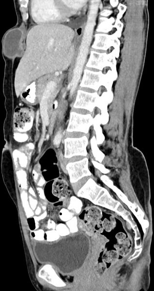File:Abdominal wall and retroperitoneal tuberculosis (Radiopaedia 88137-104729 Sagittal C+ portal venous phase 73).jpg