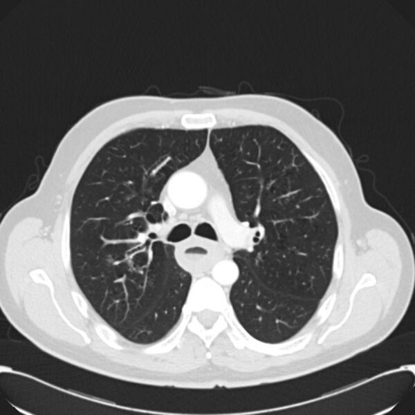 File:Achalasia (Radiopaedia 24937-25206 Axial lung window 13).jpg