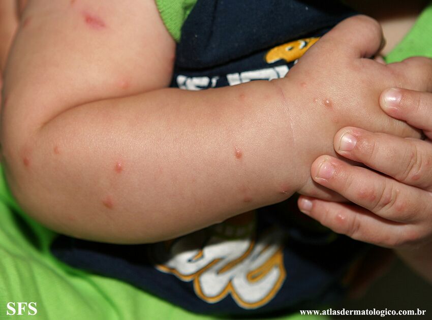 Acrodermatitis Infantile Papular (Dermatology Atlas 37).jpg