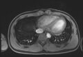 Active right ventricular cardiac sarcoidosis (Radiopaedia 55596-62100 Axial Post contrast Dixon 57).jpg