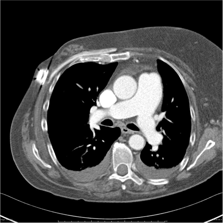 Acute-on-chronic pulmonary emboli (Radiopaedia 27925-28169 C+ CTPA 36).jpg